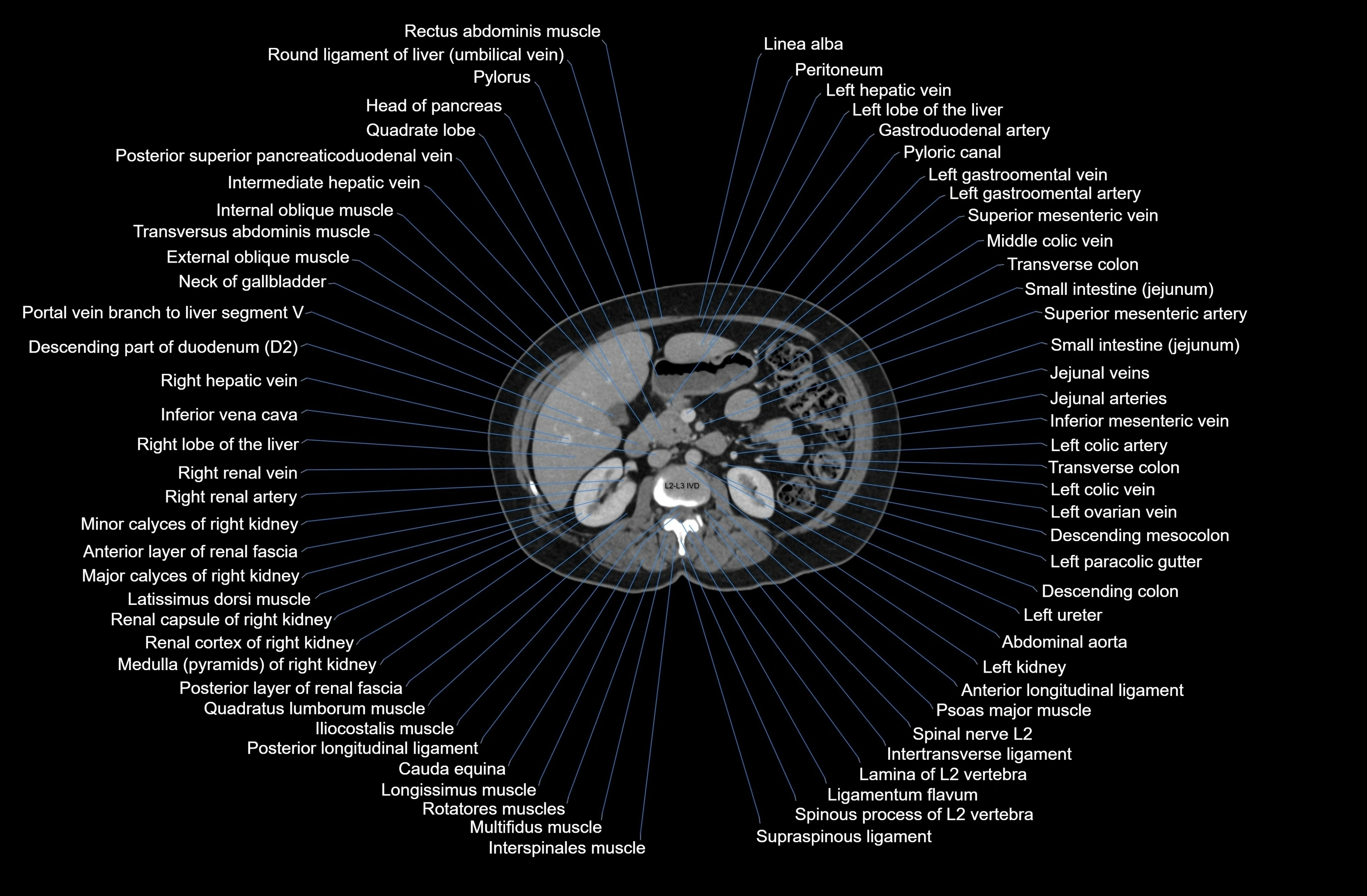 CT Abdomen axial cross sectional anatomy labelled radiology image-00037.webp